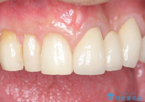 歯が折れた どうしても抜きたくない 歯の牽引で保存可能にの治療後