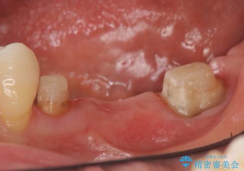 オールセラミッククラウン 欠損補綴と再生療法による深いポケットの改善の治療中