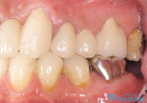 歯が折れた どうしても抜きたくない 歯の牽引で保存可能にの治療後