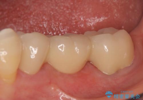 オールセラミッククラウン 欠損補綴と再生療法による深いポケットの改善の治療後