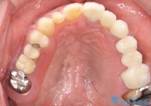 歯が折れた どうしても抜きたくない 歯の牽引で保存可能にの治療後