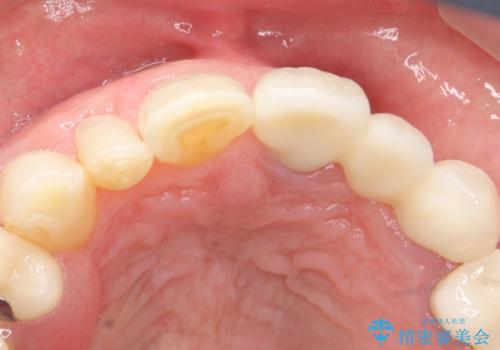 歯が折れた どうしても抜きたくない 歯の牽引で保存可能にの治療後