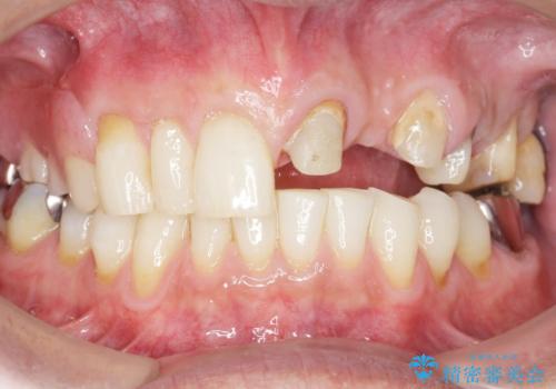 歯が折れた どうしても抜きたくない 歯の牽引で保存可能にの治療中