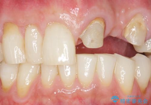 歯が折れた どうしても抜きたくない 歯の牽引で保存可能にの治療中