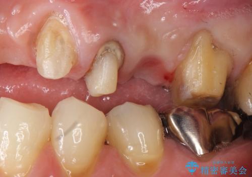 歯が折れた どうしても抜きたくない 歯の牽引で保存可能にの治療中