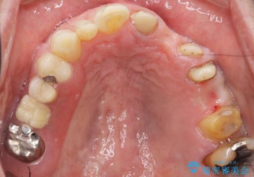 歯が折れた どうしても抜きたくない 歯の牽引で保存可能にの治療中