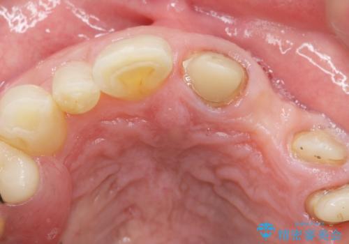 歯が折れた どうしても抜きたくない 歯の牽引で保存可能にの治療中