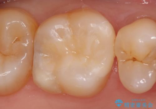 セラミックインレー 痛む歯の治療の治療後