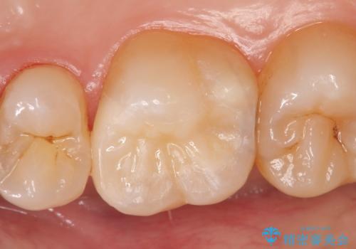 セラミックインレー 痛む歯の治療の治療後