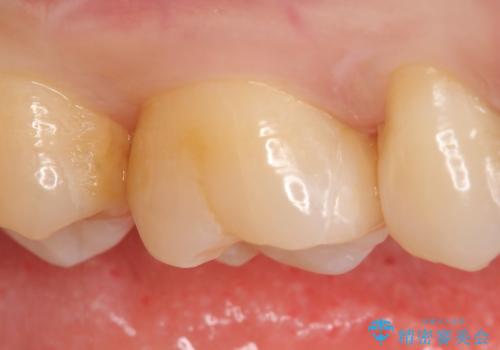 セラミックインレー 痛む歯の治療の治療後