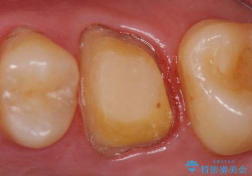 オールセラミッククラウン 精密根管治療~神経が死んでしまった歯の治療~の治療中