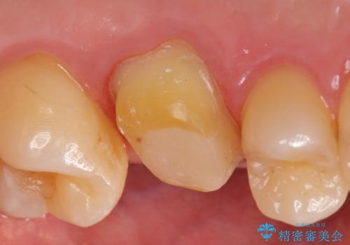 オールセラミッククラウン 精密根管治療~神経が死んでしまった歯の治療~の治療中