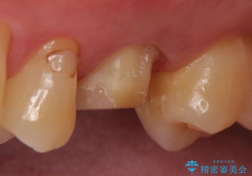 オールセラミッククラウン 精密根管治療~神経が死んでしまった歯の治療~の治療中