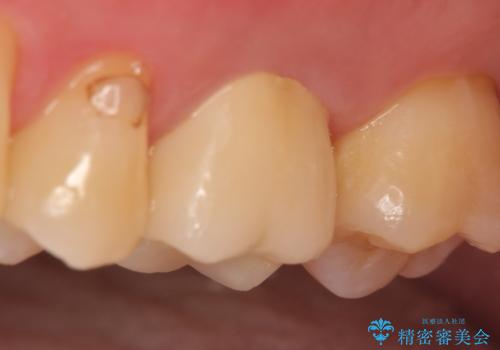 オールセラミッククラウン 精密根管治療~神経が死んでしまった歯の治療~の治療後