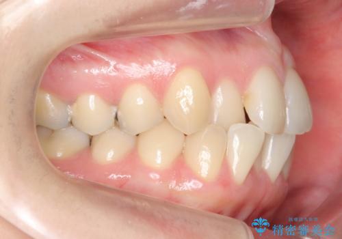 上の前歯が一部引っ込んでいる 下のがたがた マウスピース矯正の治療前