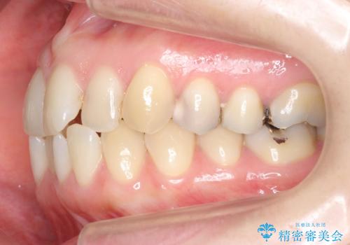 上の前歯が一部引っ込んでいる 下のがたがた マウスピース矯正の治療前