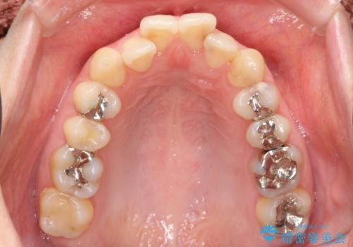 上の前歯が一部引っ込んでいる 下のがたがた マウスピース矯正の治療前