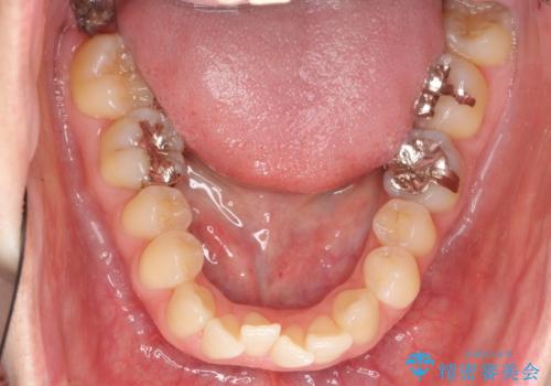 上の前歯が一部引っ込んでいる 下のがたがた マウスピース矯正の治療前