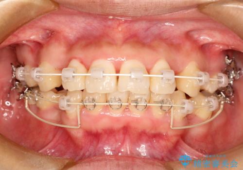 上下の歯のガタガタ　ワイヤーでの抜歯矯正で整った歯並びへの治療中