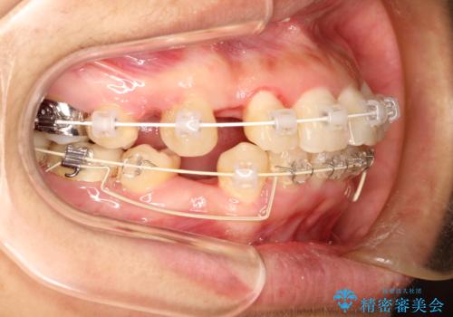 上下の歯のガタガタ　ワイヤーでの抜歯矯正で整った歯並びへの治療中