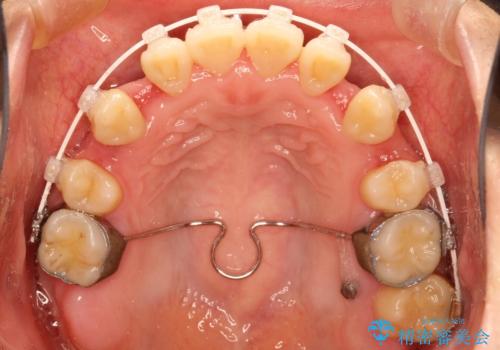 上下の歯のガタガタ　ワイヤーでの抜歯矯正で整った歯並びへの治療中
