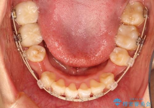 上下の歯のガタガタ　ワイヤーでの抜歯矯正で整った歯並びへの治療中