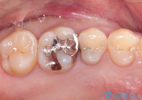 セラミックインレー メタルフリーの治療の症例 治療前