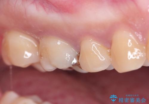 セラミックインレー メタルフリーの治療の治療前