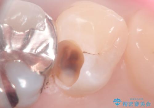 セラミックインレー メタルフリーの治療の治療中