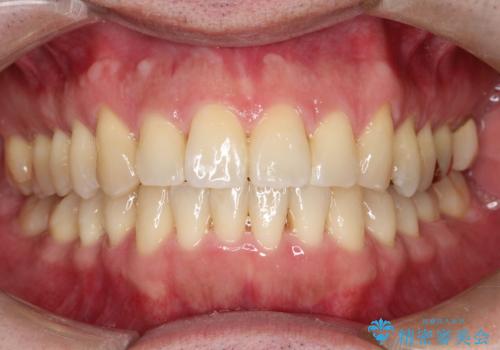 ワイヤーによる全体的ながたつきの矯正治療の症例 治療後