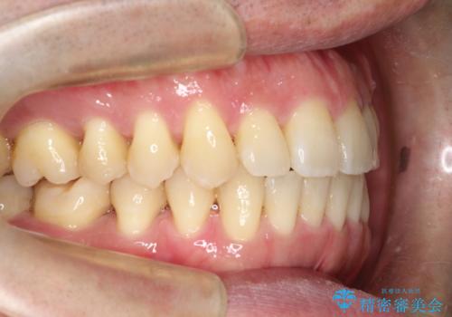 ワイヤーによる全体的ながたつきの矯正治療の治療後