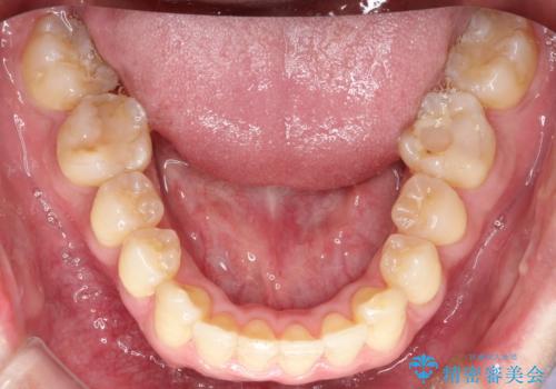 ワイヤーによる全体的ながたつきの矯正治療の治療後