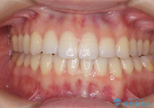 オープンバイトのインビザラインを用いた再矯正 の治療中