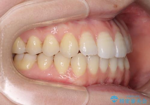 オープンバイトのインビザラインを用いた再矯正 の治療中