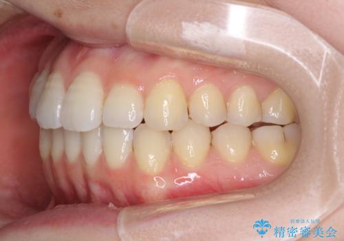 オープンバイトのインビザラインを用いた再矯正 の治療中