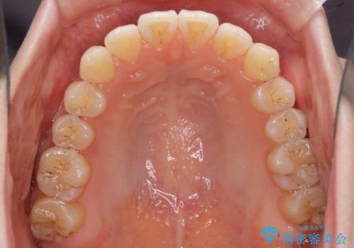 オープンバイトのインビザラインを用いた再矯正 の治療中