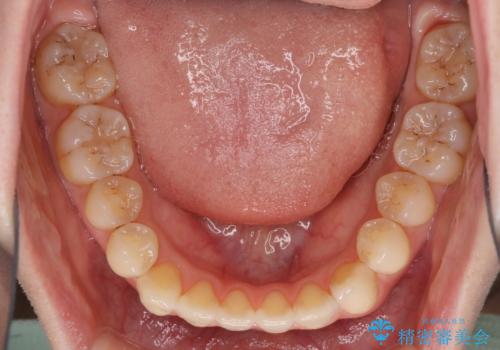 オープンバイトのインビザラインを用いた再矯正 の治療中