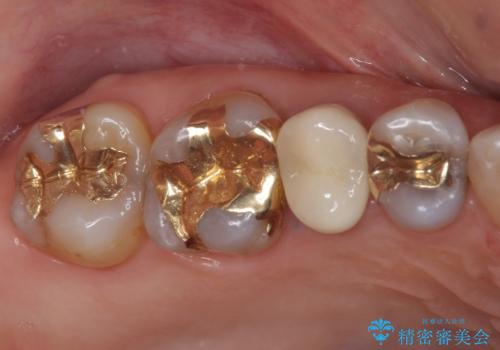 古くなったメタルボンドをオールセラミッククラウンにの治療後