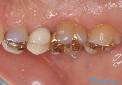 古くなったメタルボンドをオールセラミッククラウンにの治療後