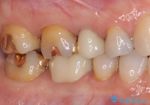 古くなったメタルボンドをオールセラミッククラウンにの治療後