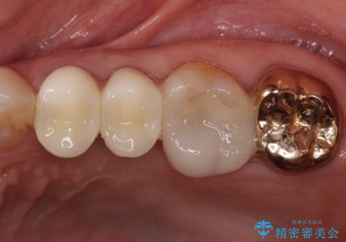古くなったメタルボンドをオールセラミッククラウンにの症例 治療後