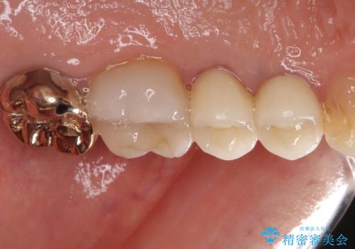 古くなったメタルボンドをオールセラミッククラウンにの治療後