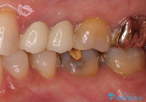 古くなったメタルボンドをオールセラミッククラウンにの治療後