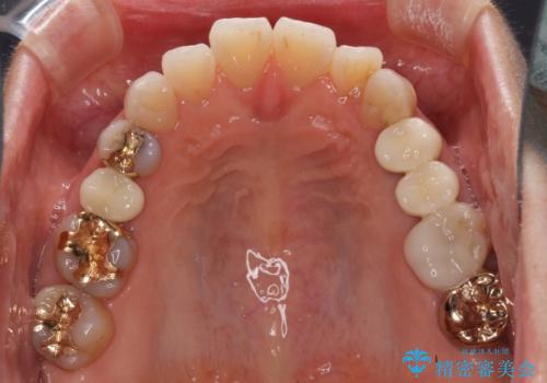 古くなったメタルボンドをオールセラミッククラウンにの治療後