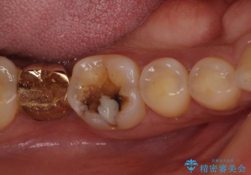 外れてしまった奥歯の銀歯　ゴールドインレーによる虫歯復療の治療前