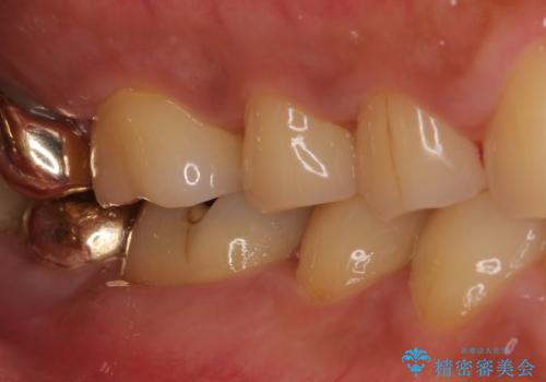 外れてしまった奥歯の銀歯 ゴールドインレーによる虫歯復療の治療前
