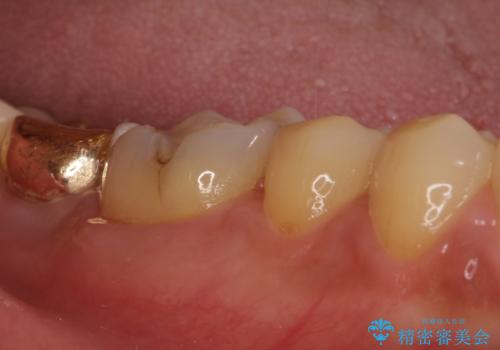 外れてしまった奥歯の銀歯 ゴールドインレーによる虫歯復療の治療前