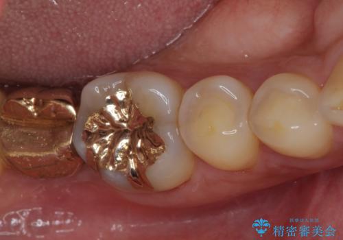 外れてしまった奥歯の銀歯 ゴールドインレーによる虫歯復療の症例 治療後