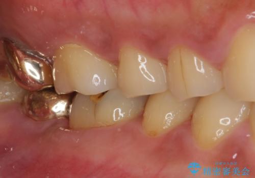 外れてしまった奥歯の銀歯 ゴールドインレーによる虫歯復療の治療後
