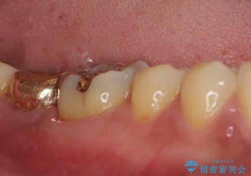 外れてしまった奥歯の銀歯 ゴールドインレーによる虫歯復療の治療後
